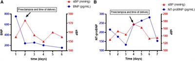 Natriuretic peptide biomarkers in the imminent development of preeclampsia